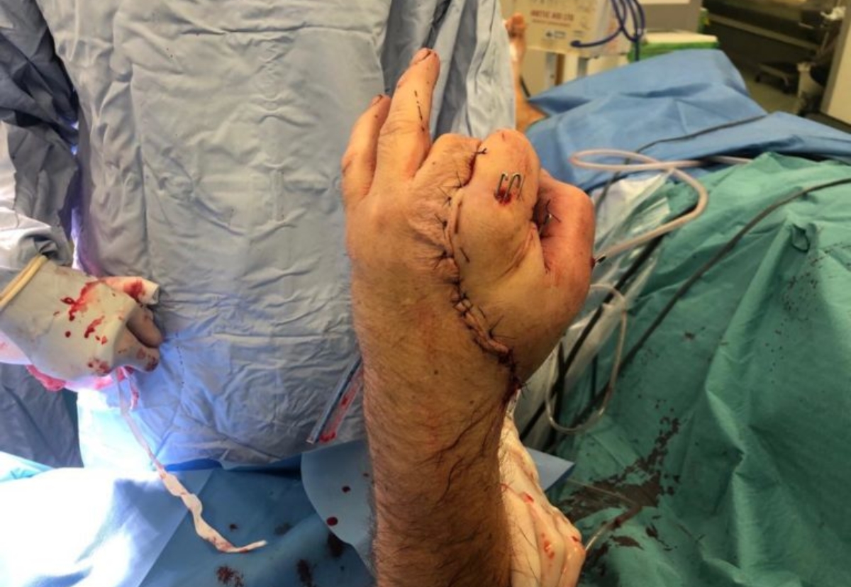 The hand was sewn back on during 17 hours of surgery